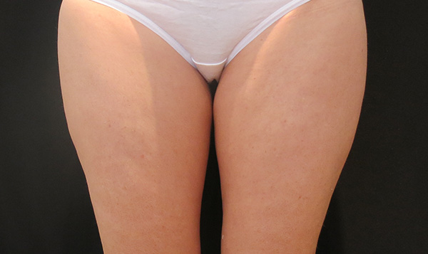 Slimmer inner thighs with a wider gap between them