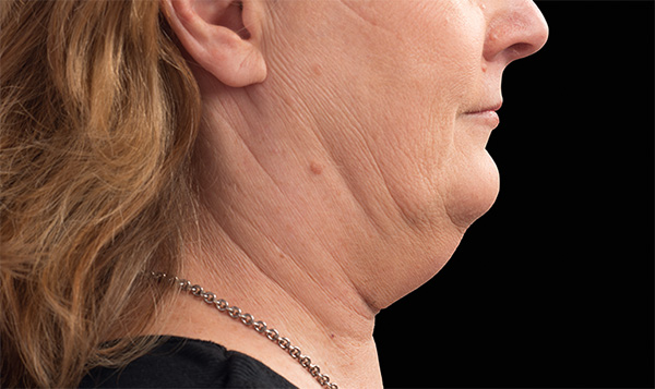 Lose that double chin to gain a more youthful you