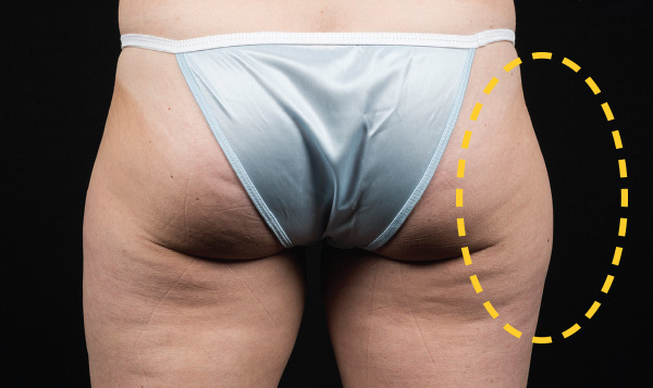 Slimmer outer thighs without the bulging fat